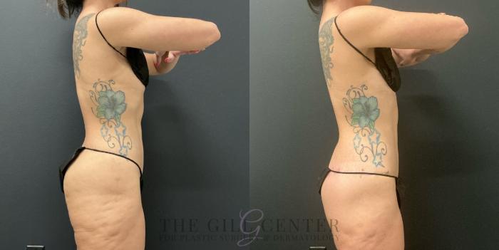 Butt Lift Case 734 Before & After Right Side | The Woodlands, TX | The Gill Center for Plastic Surgery and Dermatology