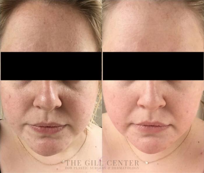 Chemical Peel Case 160 Before & After Front | The Woodlands, TX | The Gill Center for Plastic Surgery and Dermatology