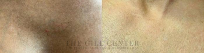 Chemical Peel Case 161 Before & After Front | The Woodlands, TX | The Gill Center for Plastic Surgery and Dermatology