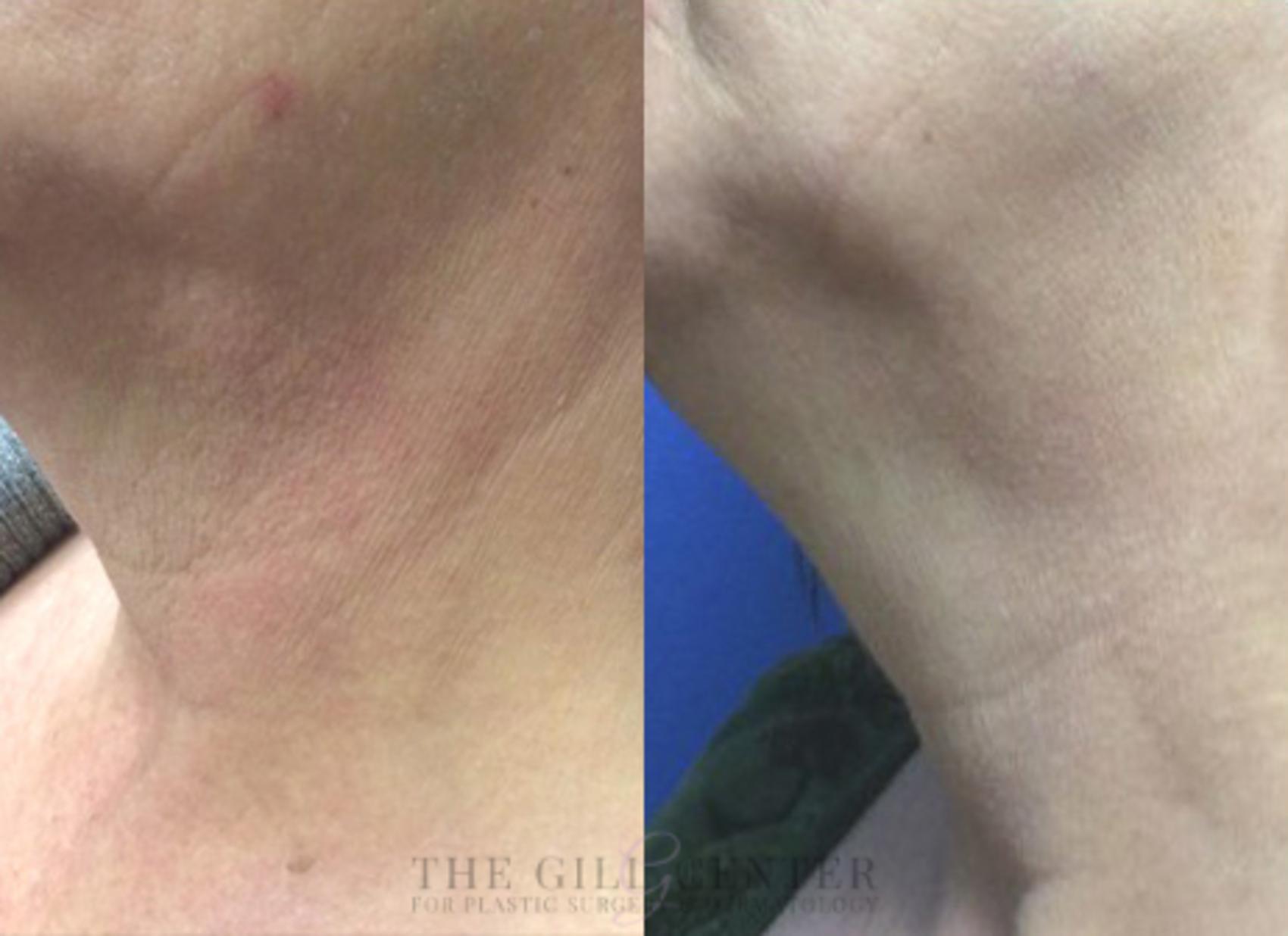 Chemical Peel Case 162 Before & After Left Oblique | The Woodlands, TX | The Gill Center for Plastic Surgery and Dermatology