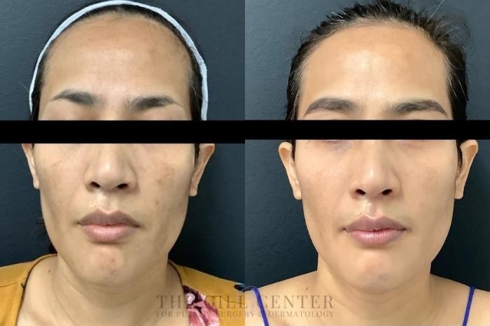 Chemical Peel Case 457 Before & After Front | The Woodlands, TX | The Gill Center for Plastic Surgery and Dermatology