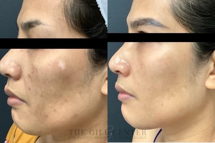 Chemical Peel Case 457 Before & After Left Side | The Woodlands, TX | The Gill Center for Plastic Surgery and Dermatology