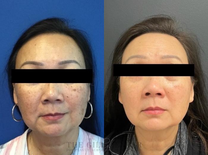 Chemical Peel Case 481 Before & After Front | The Woodlands, TX | The Gill Center for Plastic Surgery and Dermatology