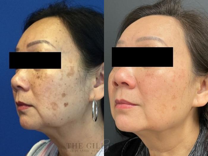 Chemical Peel Case 481 Before & After Left Side | The Woodlands, TX | The Gill Center for Plastic Surgery and Dermatology