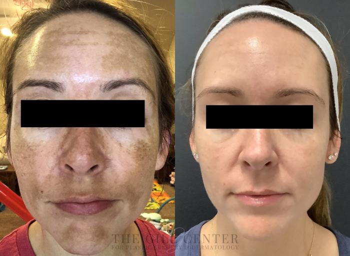 Chemical Peel Case 502 Before & After Front | The Woodlands, TX | The Gill Center for Plastic Surgery and Dermatology