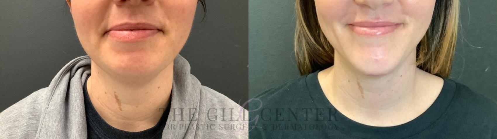 Chin Augmentation Case 512 Before & After Front | The Woodlands, TX | The Gill Center for Plastic Surgery and Dermatology