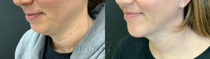 Chin Augmentation Case 512 Before & After Left Three-quarter view | The Woodlands, TX | The Gill Center for Plastic Surgery and Dermatology