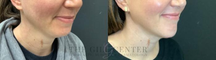 Chin Augmentation Case 512 Before & After Right Three-quarter view | The Woodlands, TX | The Gill Center for Plastic Surgery and Dermatology