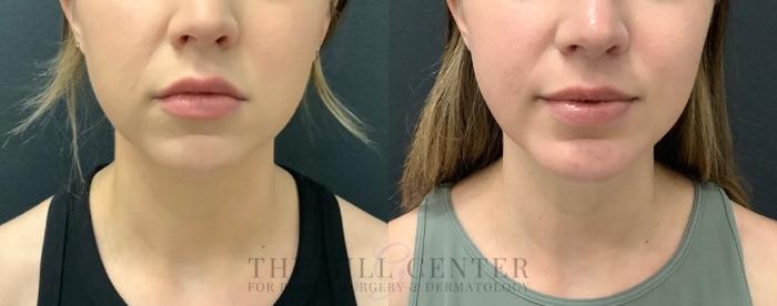 Chin Augmentation Case 563 Before & After Front | The Woodlands, TX | The Gill Center for Plastic Surgery and Dermatology