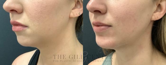 Chin Augmentation Case 563 Before & After Left Oblique | The Woodlands, TX | The Gill Center for Plastic Surgery and Dermatology