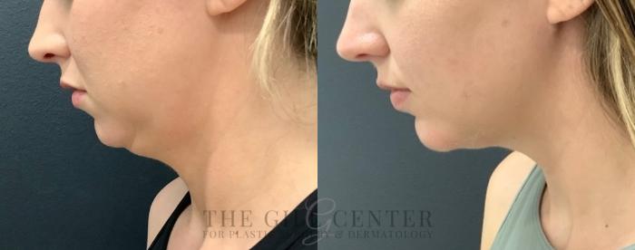 Chin Augmentation Case 563 Before & After Left Side | The Woodlands, TX | The Gill Center for Plastic Surgery and Dermatology