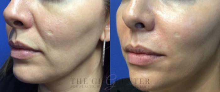 Dermal Fillers Case 353 Before & After Left Oblique | The Woodlands, TX | The Gill Center for Plastic Surgery and Dermatology