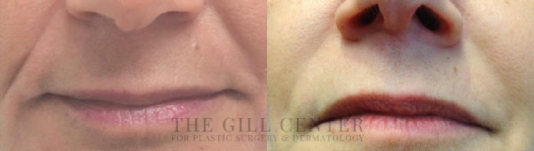Dermal Fillers Case 354 Before & After Front | The Woodlands, TX | The Gill Center for Plastic Surgery and Dermatology