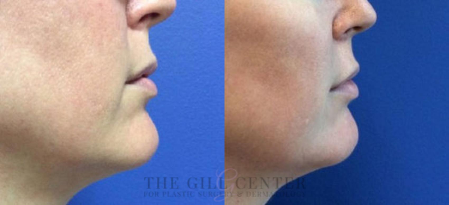 Dermal Fillers Case 357 Before & After Right Side | The Woodlands, TX | The Gill Center for Plastic Surgery and Dermatology
