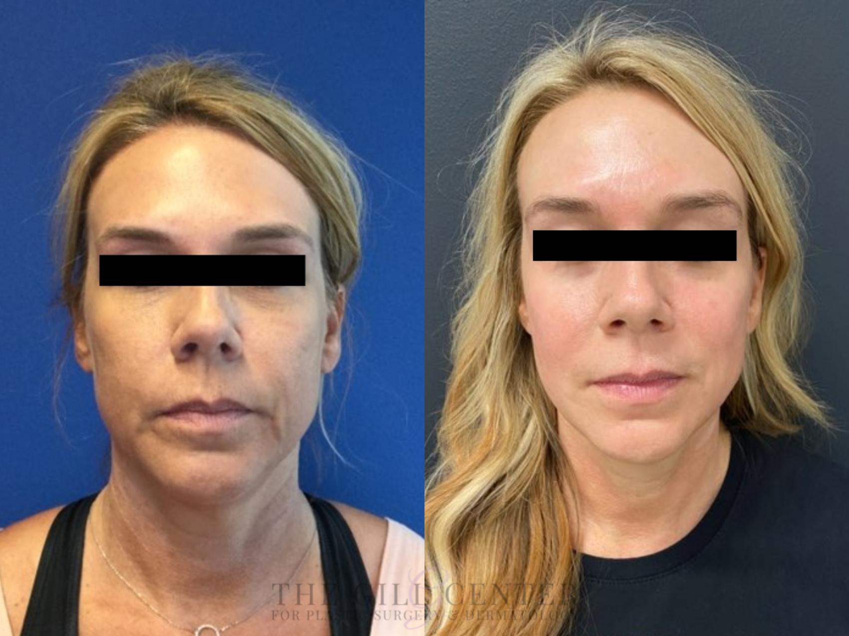 Dermal Fillers Case 531 Before & After Front | The Woodlands, TX | The Gill Center for Plastic Surgery and Dermatology
