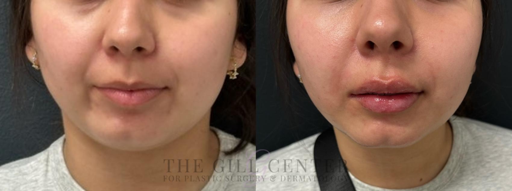 Dermal Fillers Case 658 Before & After Front | The Woodlands, TX | The Gill Center for Plastic Surgery and Dermatology