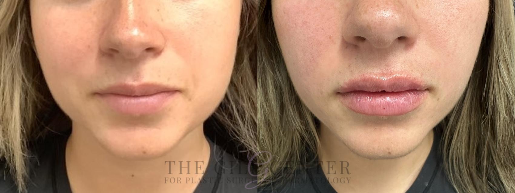 Dermal Fillers Case 659 Before & After Front | The Woodlands, TX | The Gill Center for Plastic Surgery and Dermatology