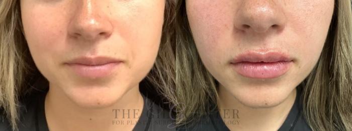 Lip Augmentation Case 659 Before & After Front | The Woodlands, TX | The Gill Center for Plastic Surgery and Dermatology