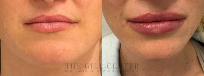 Dermal Fillers Case 660 Before & After Front | The Woodlands, TX | The Gill Center for Plastic Surgery and Dermatology