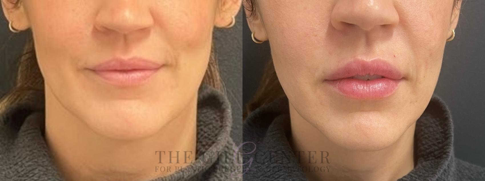 Lip Augmentation Case 662 Before & After Front | The Woodlands, TX | The Gill Center for Plastic Surgery and Dermatology