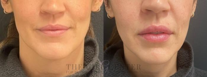 Dermal Fillers Case 662 Before & After Front | The Woodlands, TX | The Gill Center for Plastic Surgery and Dermatology