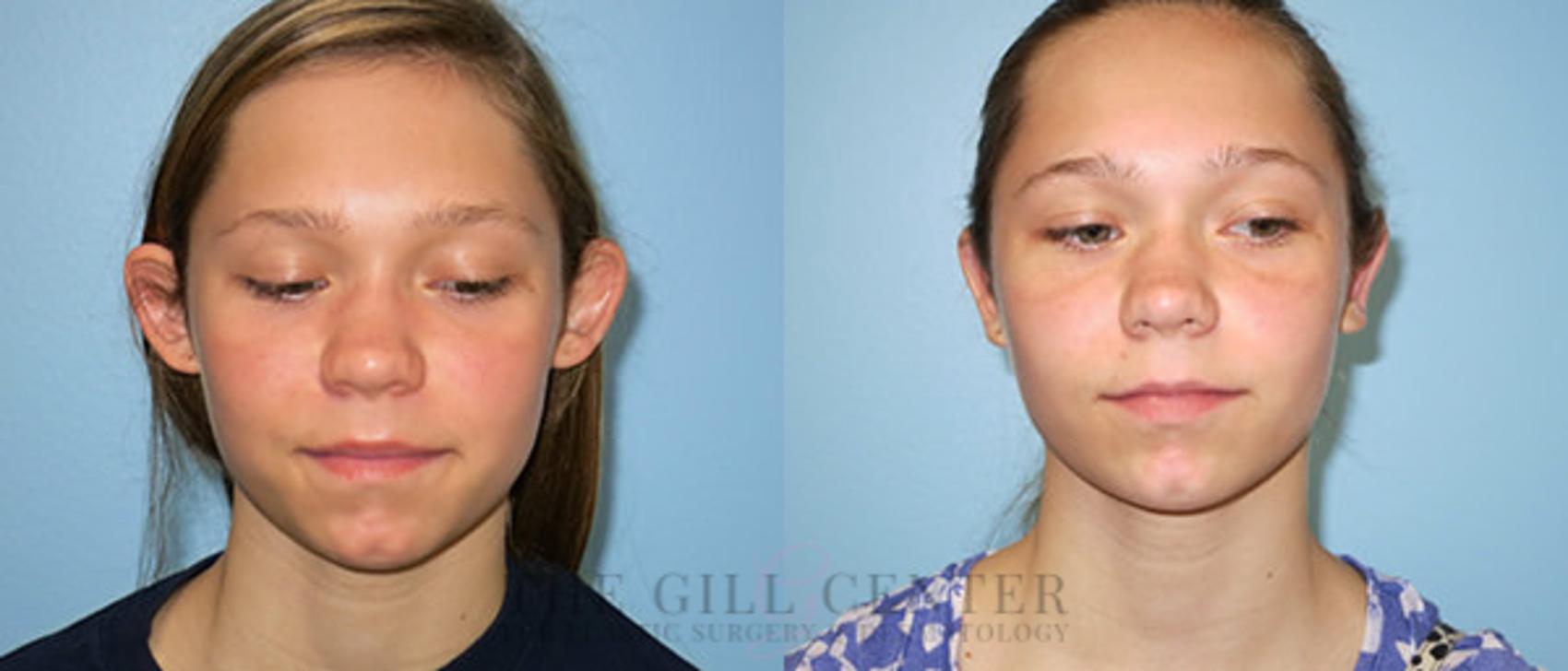 Ear Surgery Case 145 Before & After Front | The Woodlands, TX | The Gill Center for Plastic Surgery and Dermatology