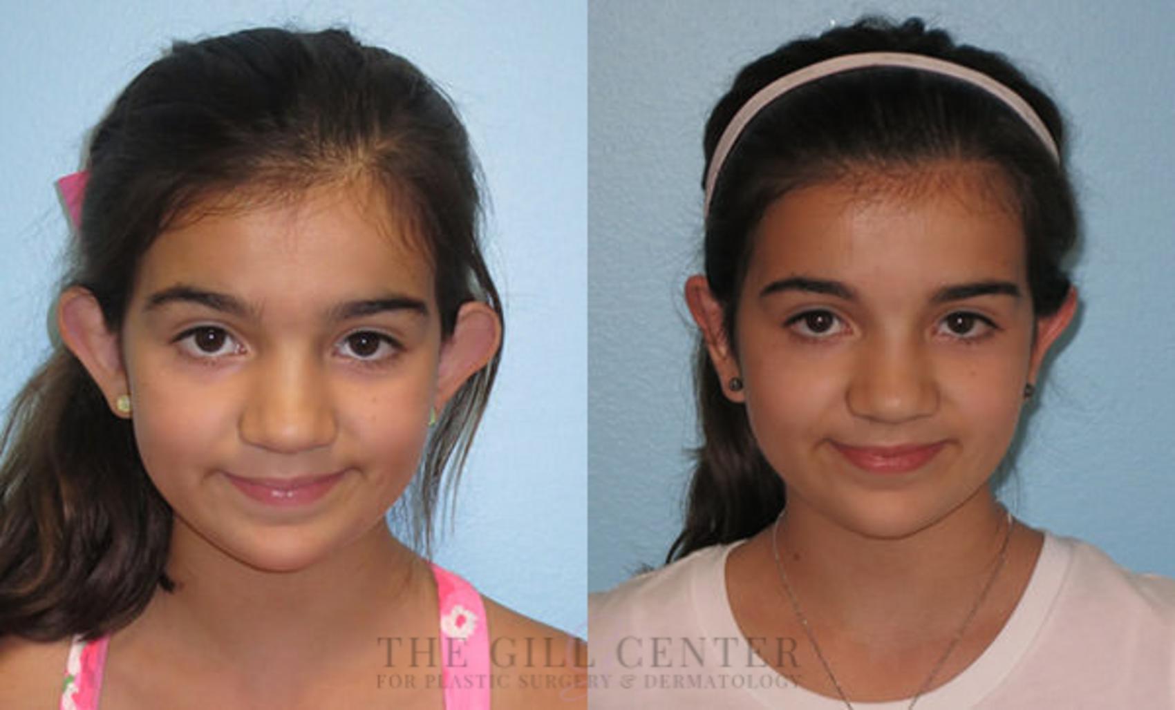 Ear Surgery Case 146 Before & After Front | The Woodlands, TX | The Gill Center for Plastic Surgery and Dermatology