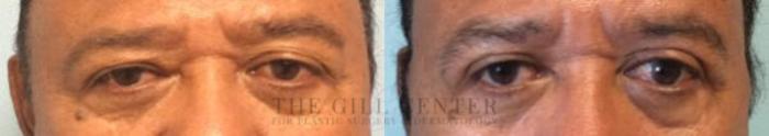 Eyelid Lift Case 147 Before & After Front | The Woodlands, TX | The Gill Center for Plastic Surgery and Dermatology