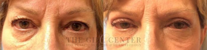 Eyelid Lift Case 148 Before & After Front | The Woodlands, TX | The Gill Center for Plastic Surgery and Dermatology