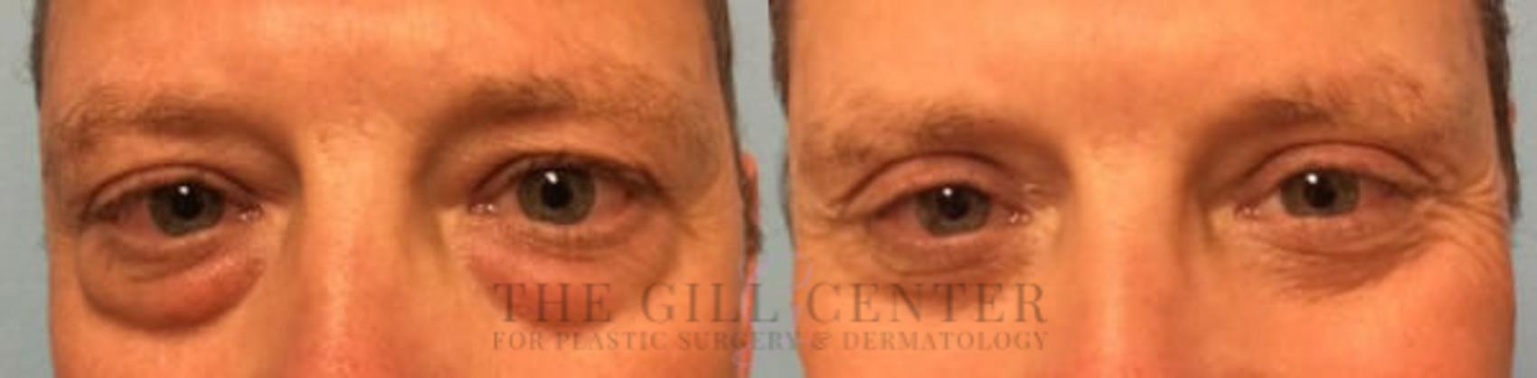 Eyelid Lift Case 149 Before & After Front | The Woodlands, TX | The Gill Center for Plastic Surgery and Dermatology