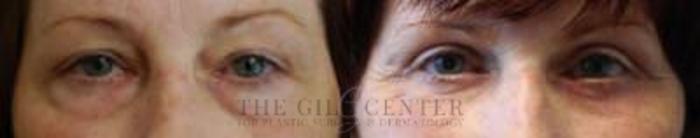 Eyelid Lift Case 151 Before & After Front | The Woodlands, TX | The Gill Center for Plastic Surgery and Dermatology