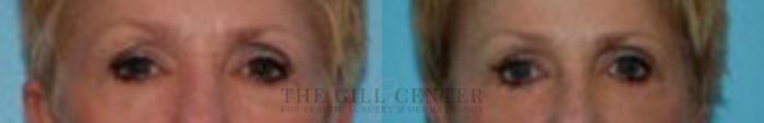 Eyelid Lift Case 152 Before & After Front | The Woodlands, TX | The Gill Center for Plastic Surgery and Dermatology