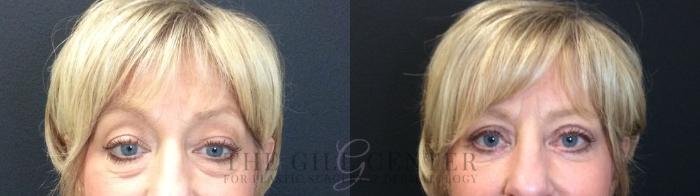 Eyelid Lift Case 432 Before & After Front | The Woodlands, TX | The Gill Center for Plastic Surgery and Dermatology