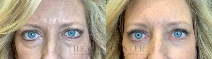 Eyelid Lift Case 464 Before & After Front | The Woodlands, TX | The Gill Center for Plastic Surgery and Dermatology