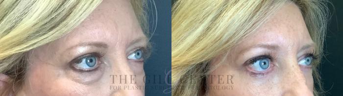 Eyelid Lift Case 464 Before & After Right Side | The Woodlands, TX | The Gill Center for Plastic Surgery and Dermatology