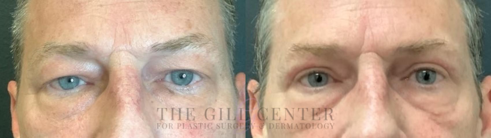 Eyelid Lift Case 518 Before & After Front | The Woodlands, TX | The Gill Center for Plastic Surgery and Dermatology