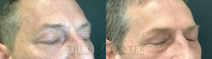 Eyelid Lift Case 518 Before & After Right Three-quarter view Eyes Closed | The Woodlands, TX | The Gill Center for Plastic Surgery and Dermatology