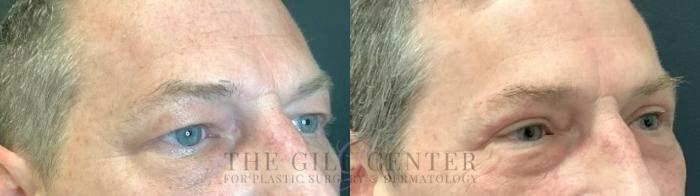 Eyelid Lift Case 518 Before & After Right Three-quarter view | The Woodlands, TX | The Gill Center for Plastic Surgery and Dermatology