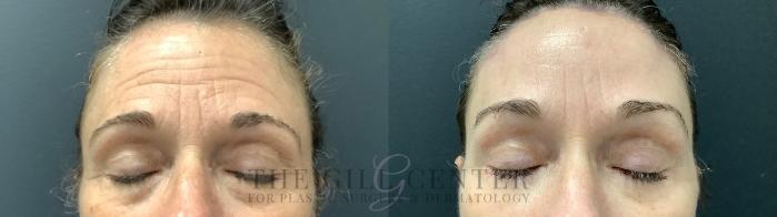 Eyelid Lift Case 527 Before & After Eyes Closed | The Woodlands, TX | The Gill Center for Plastic Surgery and Dermatology