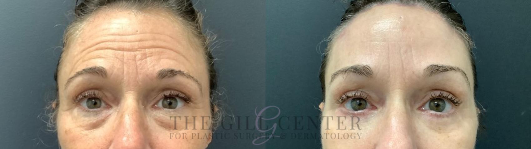 Eyelid Lift Case 527 Before & After Front | The Woodlands, TX | The Gill Center for Plastic Surgery and Dermatology