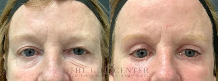 Eyelid Lift Case 562 Before & After Front | The Woodlands, TX | The Gill Center for Plastic Surgery and Dermatology