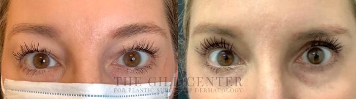 Eyelid Lift Case 613 Before & After Front | The Woodlands, TX | The Gill Center for Plastic Surgery and Dermatology