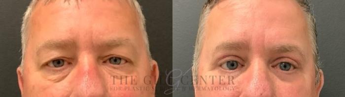 Eyelid Lift Case 618 Before & After Front | The Woodlands, TX | The Gill Center for Plastic Surgery and Dermatology