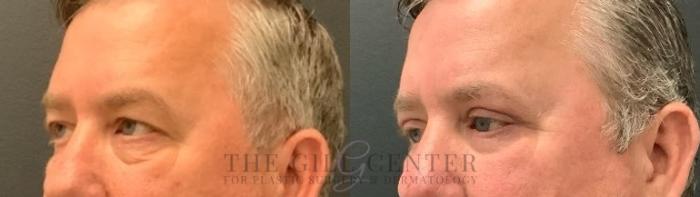 Eyelid Lift Case 618 Before & After Left Oblique | The Woodlands, TX | The Gill Center for Plastic Surgery and Dermatology