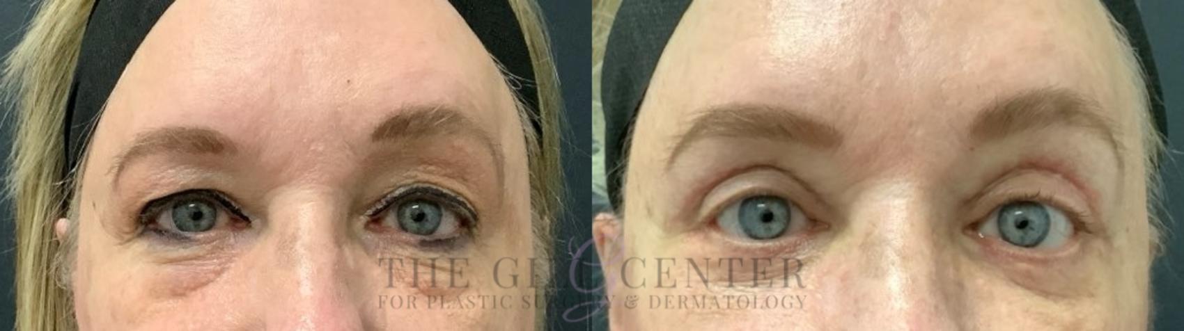 Eyelid Lift Case 625 Before & After Front | The Woodlands, TX | The Gill Center for Plastic Surgery and Dermatology