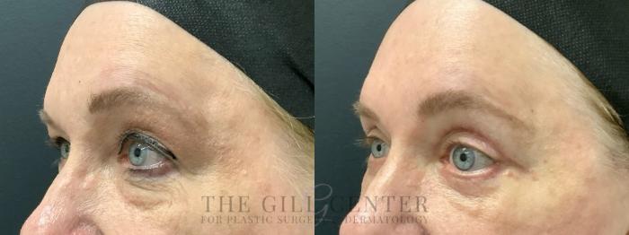 Eyelid Lift Case 625 Before & After Left Oblique | The Woodlands, TX | The Gill Center for Plastic Surgery and Dermatology