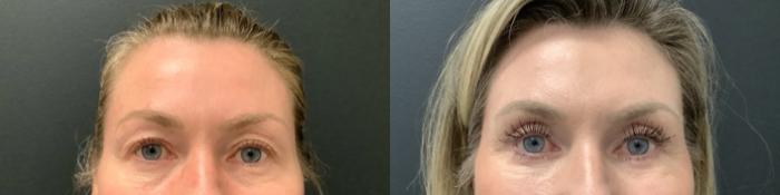 Eyelid Lift Case 663 Before & After Front | The Woodlands, TX | The Gill Center for Plastic Surgery and Dermatology