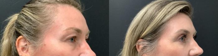 Eyelid Lift Case 663 Before & After Right Side | The Woodlands, TX | The Gill Center for Plastic Surgery and Dermatology