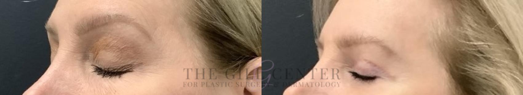 Eyelid Lift Case 705 Before & After Left side with eyes closed | The Woodlands, TX | The Gill Center for Plastic Surgery and Dermatology