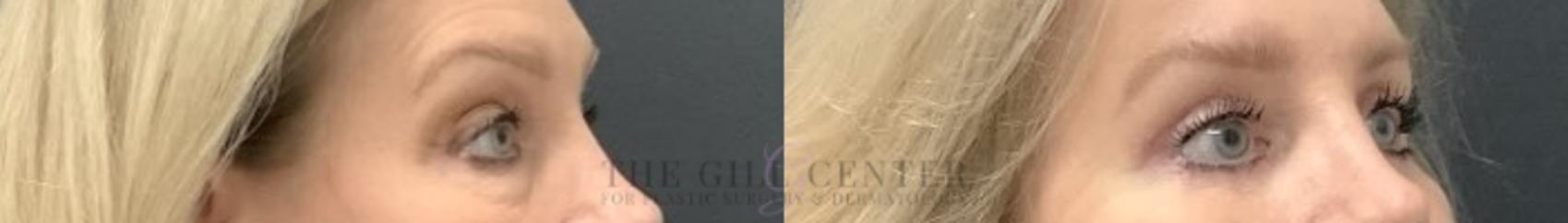 Eyelid Lift Case 705 Before & After Right Side | The Woodlands, TX | The Gill Center for Plastic Surgery and Dermatology